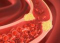 When combating excessive blood cholesterol